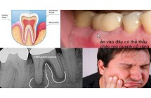 Viêm Chân Răng - Nguyên Nhân Và Cách Điều Trị